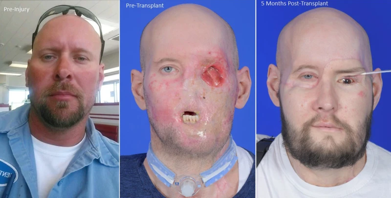Esta combinación de fotografías proporcionadas por NYU Langone Health en noviembre de 2023 muestra a Aaron James antes y después de su accidente eléctrico de alto voltaje y después de un trasplante facial y ocular. 